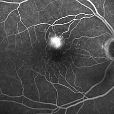 Angiographie bei feuchter Makuladegeneration (Gef&auml;&szlig;neubildung in der Makula)
