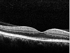 OCT-Bild einer normalen Makula (Stelle des sch&auml;rfsten Sehens der Netzhaut) mit typischer zentraler Einsenkung (Fovea)