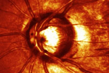 Fotografie des Sehnervenkopfes mit einer zentralen Aush&ouml;hlung des Nerven bei einem Patienten mit Glaukom