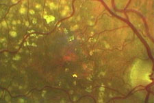 Stoffwechselablagerungen in der Netzhaut, sog. Drusen der Makula, als Zeichen einer beginnenden Makula-Degeneration