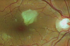 Vermehrte Schl&auml;ngelung der Gef&auml;&szlig;e und Mikroinfarkt am Augenhintergrund bei einem Patienten mit erh&ouml;htem Blutdruck