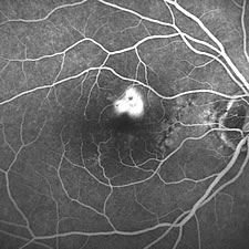 Farbstoffdarstellung einer krankhaften Blutgef&auml;&szlig;neubildung (Neovaskularisation) im Bereich der Stelle des sch&auml;rfsten Sehens der Netzhaut