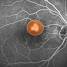 Bestrahlung der Neovaskularisation mit dem roten Laser, nachdem der Photosensibilisator intraven&ouml;s injiziert wurde